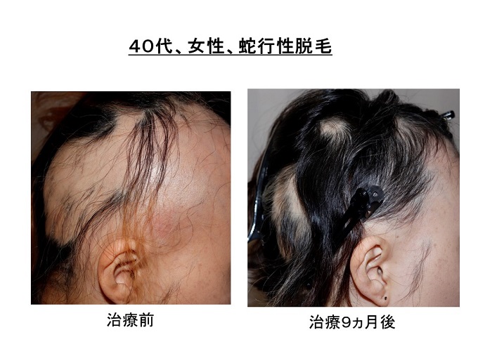 円形脱毛症　病院